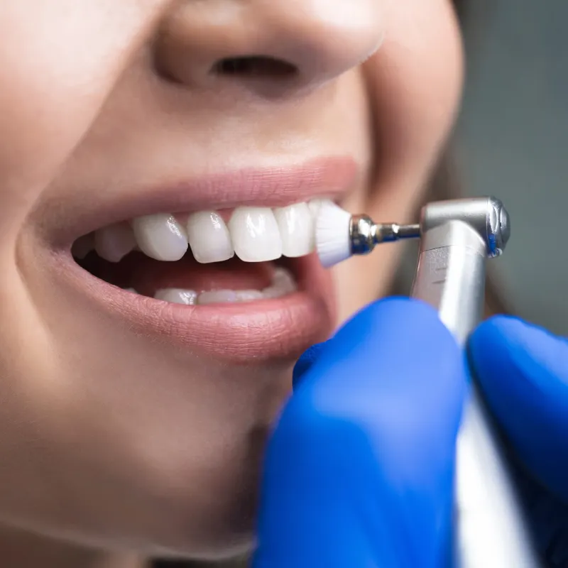 limpieza dental marbella