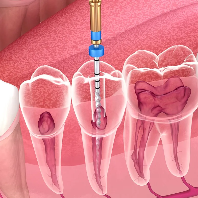 especialista endodoncia marbella