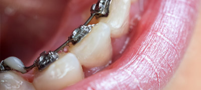 ortodoncia_lingual